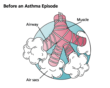 Illustration of an area of the lung before an asthma episode showing the airways, muscle, and air sacs. 